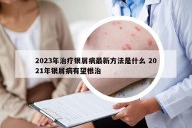 2023年治疗银屑病最新方法是什么 2021年银屑病有望根治