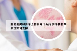 脸的面夹和鼻子上有癣用什么药 鼻子和脸颊长斑如何去掉
