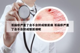 荨麻疹严重了会不会转成银屑病 荨麻疹严重了会不会转成银屑病呢