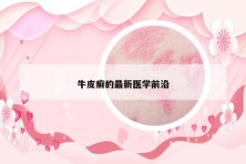 牛皮癣的最新医学前沿