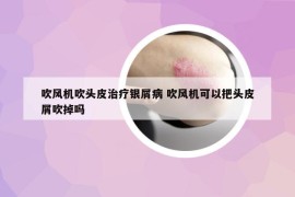 吹风机吹头皮治疗银屑病 吹风机可以把头皮屑吹掉吗