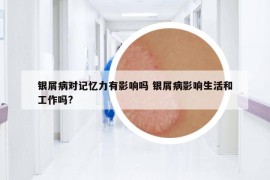 银屑病对记忆力有影响吗 银屑病影响生活和工作吗?