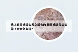 头上银屑病烫头发之后有的 银屑病烫发染头发了会会怎么样?