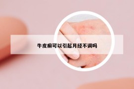 牛皮癣可以引起月经不调吗
