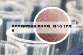 类银屑病和银屑病 类银屑病一般长在什么地方