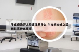 牛皮癣治好之后该注意什么 牛皮癣治好之后该注意什么事项