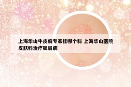 上海华山牛皮癣专家挂哪个科 上海华山医院皮肤科治疗银屑病