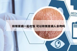 和银屑病一起吃饭 可以和银屑病人亲吻吗