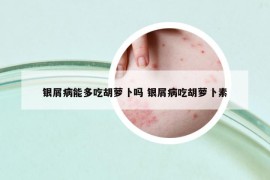 银屑病能多吃胡萝卜吗 银屑病吃胡萝卜素