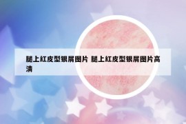 腿上红皮型银屑图片 腿上红皮型银屑图片高清