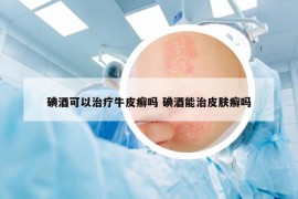 碘酒可以治疗牛皮癣吗 碘酒能治皮肤癣吗