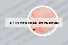 身上长了牛皮癣会传染吗 有牛皮癣会传染吗
