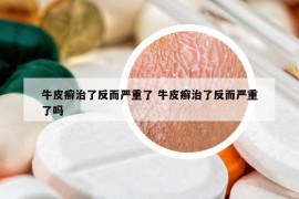 牛皮癣治了反而严重了 牛皮癣治了反而严重了吗