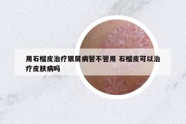 用石榴皮治疗银屑病管不管用 石榴皮可以治疗皮肤病吗