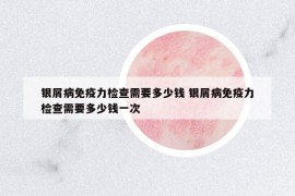 银屑病免疫力检查需要多少钱 银屑病免疫力检查需要多少钱一次