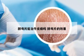 酵母片能治牛皮癣吗 酵母片的效果