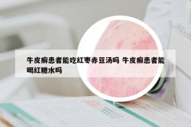 牛皮癣患者能吃红枣赤豆汤吗 牛皮癣患者能喝红糖水吗