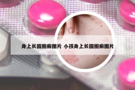 身上长圆圈癣图片 小孩身上长圆圈癣图片