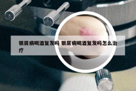 银屑病喝酒复发吗 银屑病喝酒复发吗怎么治疗