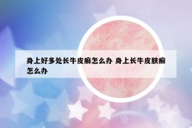 身上好多处长牛皮癣怎么办 身上长牛皮肤癣怎么办