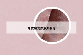 牛皮癣发作多久会好