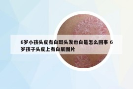 6岁小孩头皮有白斑头发也白是怎么回事 6岁孩子头皮上有白屑图片