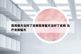 我用偏方治好了皮癣我用偏方治好了皮癣 治疗皮癣偏方