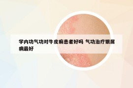学内功气功对牛皮癣患者好吗 气功治疗银屑病最好