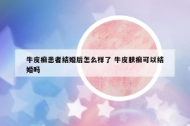 牛皮癣患者结婚后怎么样了 牛皮肤癣可以结婚吗