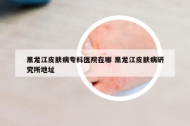 黑龙江皮肤病专科医院在哪 黑龙江皮肤病研究所地址