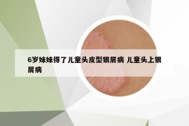 6岁妹妹得了儿童头皮型银屑病 儿童头上银屑病