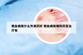 银血病用什么外用药好 银血病有哪种药膏治疗有
