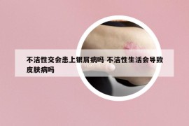 不洁性交会患上银屑病吗 不洁性生活会导致皮肤病吗