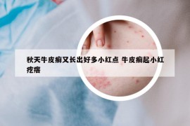 秋天牛皮癣又长出好多小红点 牛皮癣起小红疙瘩