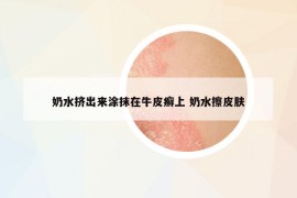 奶水挤出来涂抹在牛皮癣上 奶水擦皮肤