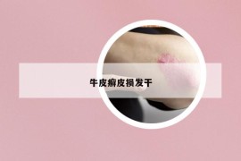 牛皮癣皮损发干