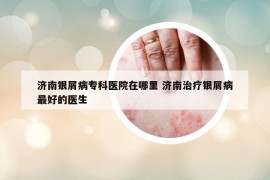 济南银屑病专科医院在哪里 济南治疗银屑病最好的医生