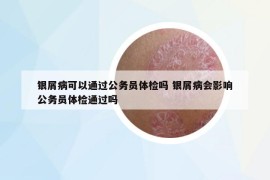 银屑病可以通过公务员体检吗 银屑病会影响公务员体检通过吗