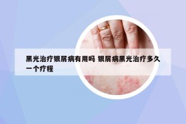 黑光治疗银屑病有用吗 银屑病黑光治疗多久一个疗程