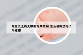 为什么无缘无故的得牛皮癣 怎么会突然得了牛皮癣
