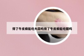 得了牛皮癣能吃大蒜吗得了牛皮癣能吃醋吗