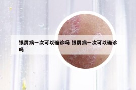 银屑病一次可以确诊吗 银屑病一次可以确诊吗