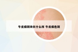 牛皮癣斑块长什么样 牛皮癣色斑