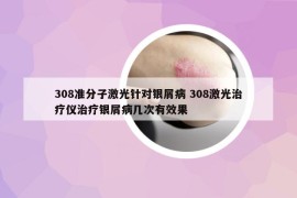 308准分子激光针对银屑病 308激光治疗仪治疗银屑病几次有效果