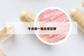 牛皮癣一般出现在哪