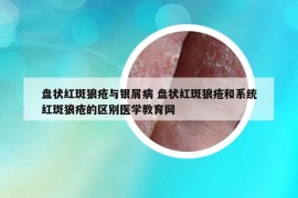 盘状红斑狼疮与银屑病 盘状红斑狼疮和系统红斑狼疮的区别医学教育网