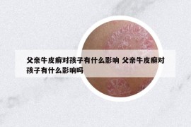 父亲牛皮癣对孩子有什么影响 父亲牛皮癣对孩子有什么影响吗