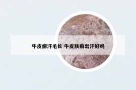 牛皮癣汗毛长 牛皮肤癣出汗好吗