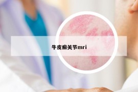 牛皮癣关节mri