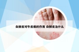 白鲜皮对牛皮癣的作用 白鲜皮治什么
